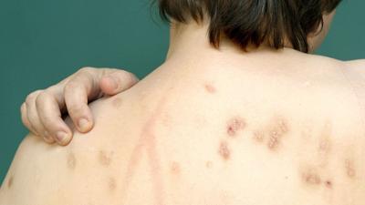 Gesundheit!: Abenteuer Diagnose: Alpha Gal Syndrom und Amöben