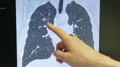 Gesundheit!: Lungenkrebsscreening, Gelenkschmerzen, Berberitze, Tango