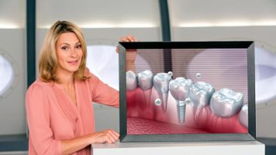 Wissen vor acht: Zahnimplantate – Ein Mund voller Überraschungen Wissen vor acht: Zahnimplantate – Ein Mund voller Überraschungen